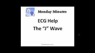 ECG Help  J Wave [upl. by Kassity200]