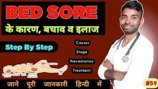 bed sores treatment in hindi  stage causes prevention  pressure ulcers  decubitus ulcers [upl. by Inor188]