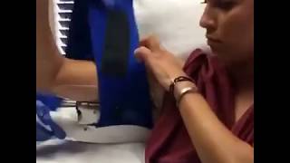 Coolsculpting NonSurgical Fat Reduction of the Upper Arm [upl. by Naanac]