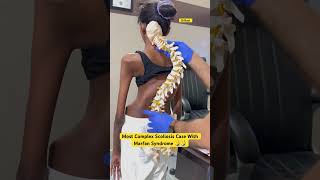 Most complex scoliosis case with Marfan syndrome treatment by DrRavi scoliosis chiropractor chiro [upl. by Dorelle]