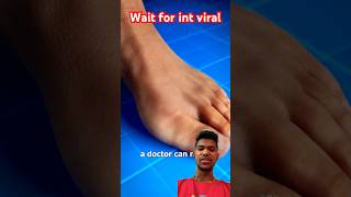 Bunion correctiorshorts viralvideo trending Short [upl. by Ecnarwal]