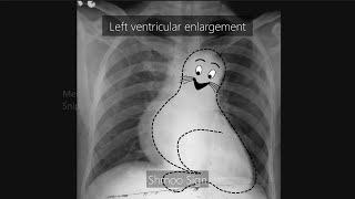 Cardiac borders and chambers in Chest X Ray [upl. by Cirre]