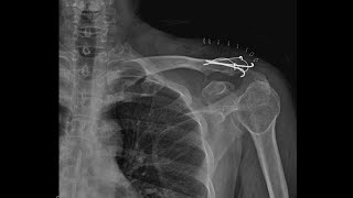 Distal clavicle fracture [upl. by Erait]