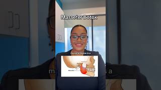 Masseter Botox Benefits✨ [upl. by Eilujna]