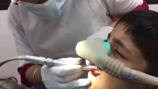 Dental Treatment under Laughing Gas Anaesthesia [upl. by Aiepoissac]