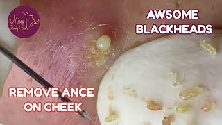 Remove AWESOME BLACKHEADS Relaxing Moments in The City ANCE CHEEK Acne TreatmentJosefa M Reina [upl. by Adarbil]