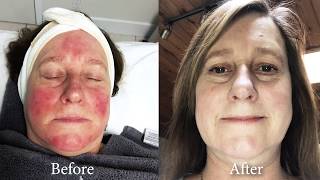 Effective Rosacea Treatment  For Redness Pimples Swelling On Face Call 604 6965506  Vancouver [upl. by Pillihpnhoj]