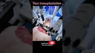 Face Transplantation  Face changes after surgery facetransformation  facechange [upl. by Marv540]