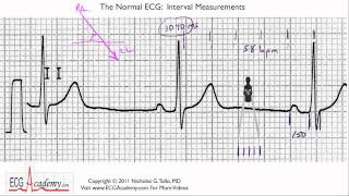 Interval Measurements 64  ECG  EKG Interpretation  BASIC [upl. by Rehptsirhc]