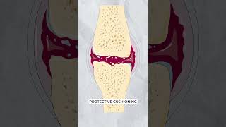 Osteoarthritis vs Osteoporosis [upl. by Eimor]