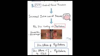 The 3 Important Causes of Papilledema Shorts [upl. by Ikcir873]