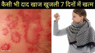 दाद खाज खुजली का घरेलू उपचारdaad khaj khujli ko jad se khatam karne ka upayskin disease [upl. by Aeriel]