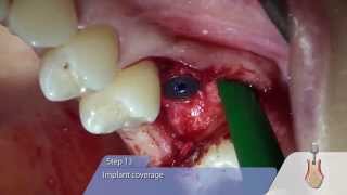 OT medical OTF3 ImplantInsertion with Sinus LiftOsteotomy [upl. by Htnamas]