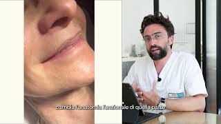 Medicina Estetica Scioglimento Filler  Ialuronidasi  PREPOST  Studio Borbon Milano [upl. by Nicks]