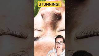 ULTIMATE PORE STRIP REMOVAL  How To Prep Skin For Pore Strips shorts [upl. by Studnia]