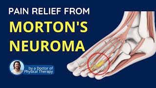 Relief from Mortons Neuroma Foot pain  Symptoms and Causes [upl. by Madora]