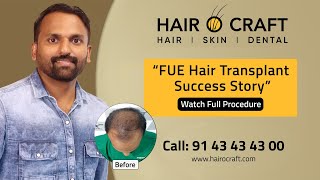 FUE Hair Transplant Success Stories EXPOSED [upl. by Gnos]