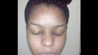 How kojic acid soap changed my face week 4 before and after pictures [upl. by Nhojleahcim]