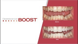 StepbyStep Opalescence Boost Teeth Whitening Procedure  Australia [upl. by Odrautse]