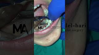 extraction of malposed lower second premolar using forceps [upl. by Hastie]