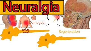 Neuralgia Explained under 3 minutes Trigeminal Neuralgia symptoms and treatment [upl. by Ahsirhcal]