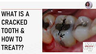 Treatment for cracked teeth [upl. by Pru]