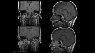 Neuroimaging review cases part 1 Dr Amr Saadawy [upl. by Zawde]