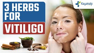 3 Best Herbs for Vitiligo  Home Remedies for Vitiligo Relief  Kayakalp Global [upl. by Maybelle45]