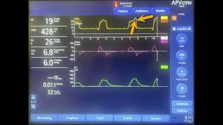 Delayed Cycling on Mechanical Ventilation [upl. by Lsiel]