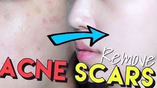 How To Get Rid of Acne Scars amp Hyperpigmentation • Get Brighter Skin [upl. by Isnyl436]