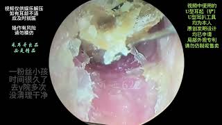 The ear canal is blocked with fungal dry patches [upl. by Dnanidref]