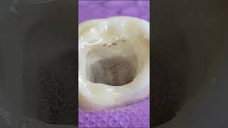 TOOTH CAVITY restoration rootcanal shorts [upl. by Eirahs]