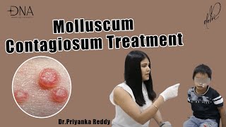 How to treat Molluscum Contagiosum  Treatment of viral skin infection  Dr Priyanka Reddy [upl. by Nolahc540]