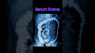 Barium Enema  Barium xray procedure  anatomy radiology xray [upl. by Connell]