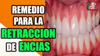 Mis dientes y boca parecían de anciana por la retracción de encías [upl. by Ztnahc]