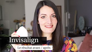 Invisalign le résultat avant  après  Rendezvous Durée fil de contention [upl. by Lorant]