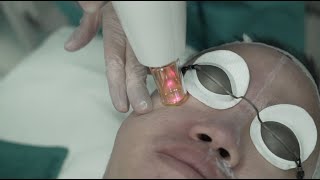 30 treatments in 1  M22 Lumenis Skin Treatment Laser [upl. by Hctud]