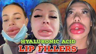 LIP INJECTIONS WITH NO NEEDLE [upl. by Northrup]