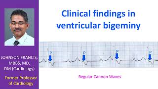 Ventricular Bigeminy and Clinical Findings [upl. by Doner]