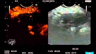 EUSGuided FineNeedle Aspiration for the Diagnosis amp Staging of Pancreatic Masses [upl. by Akihsay682]