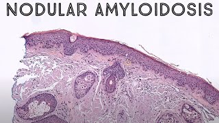 Nodular Amyloidosis AL light chain amyloidosis in skin pathology dermpath dermatology [upl. by Deeas]