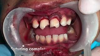 Teeth avulsion and reimplantation using orthodontic retention wire [upl. by Philan]