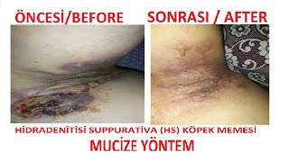 HİDRADENİTİS SUPPURATİVA HS KÖPEK MEMESİ ÖNCESİ BEFORE  SONRASI  AFTER MUCİZEYÖNTEM [upl. by Oivat485]