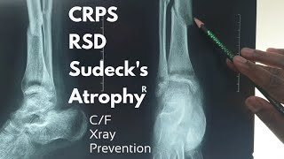 CRPSRSDSudecks AtrophyAlgodystrophy  CF amp Xray findings amp prevention  Dr Abdullah Al Rafi [upl. by Akitahs]