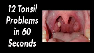 12 Tonsil Problems in 60 Seconds [upl. by Dotson431]