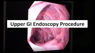 Upper GI Endoscopy Procedure in the ED [upl. by Eladnor]