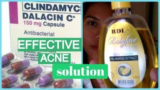 DALACIN C FOR ACNE DARK SPOTS  HIGHLY EFFECTIVE ACNEPIMPLE SOLUTION  Helmz Jordan [upl. by Abbate]