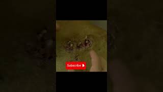 Extraction de vers parasites Removing mango worms shorts parasite worms mangowormsremoval [upl. by Hnil]