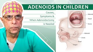 Adenoids in Children Causes Symptoms amp When Adenoidectomy is Needed  Dr Major Rajesh Bhardwaj [upl. by Yeblehs]