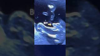 13 Week  Ultrasound Showing baby boy  Gender Ultrasound  Uk shorts [upl. by Harbed44]